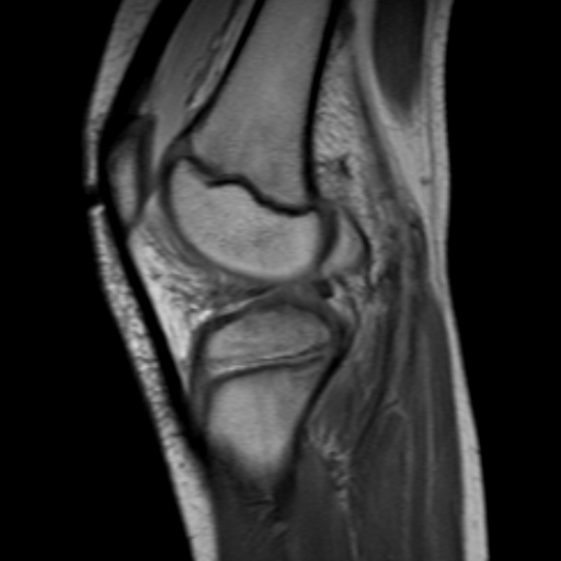 File:Anterior cruciate ligament avulsion fracture (Radiopaedia 24710-24974 Sagittal T1 8).jpg