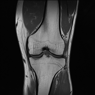 File:Anterior cruciate ligament full thickness tear (Radiopaedia 66268-75467 Coronal T1 11).jpg
