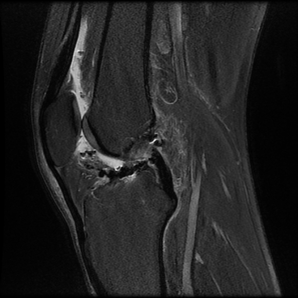 File:Anterior cruciate ligament graft tear and bucket-handle tear of medial meniscus (Radiopaedia 75867-87255 Sagittal PD fat sat 15).jpg