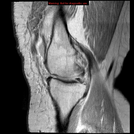 File:Anterior cruciate ligament tear (Radiopaedia 12329-12612 Sagittal T2 fat sat 14).jpg