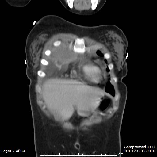 File:Anterior mediastinal B cell Lymphoma (Radiopaedia 50677-56114 B 4).jpg