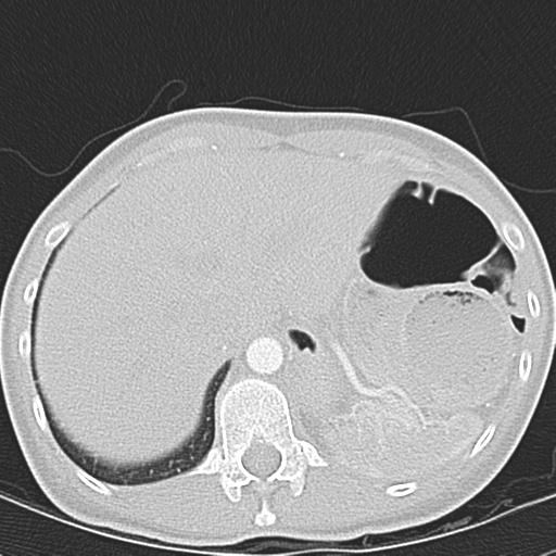 Anterior mediastinal lymphoma (Radiopaedia 29556-30061 Axial lung window 51).jpg