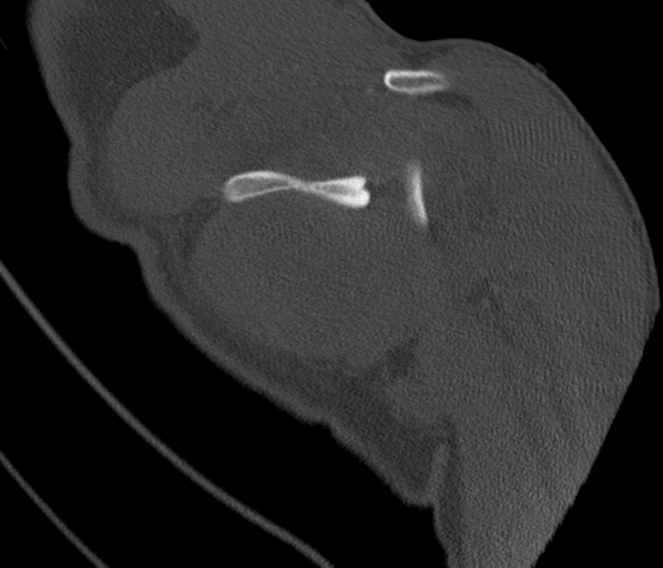 Anterior shoulder dislocation with Hill-Sachs and bony Bankart lesions (Radiopaedia 40424-42974 Coronal bone window 35).png