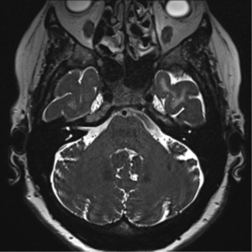 Anterior temporal pole cysts (Radiopaedia 46629-51102 Axial T2 35).png