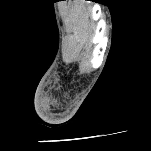 Anterior tibial artery false aneurysm (Radiopaedia 88984-105809 A 239).jpg