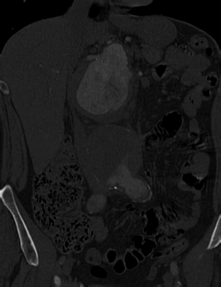 Anterior vertebral scalloping (abdominal aortic aneurysm) (Radiopaedia 66744-76067 Coronal bone window 12).jpg