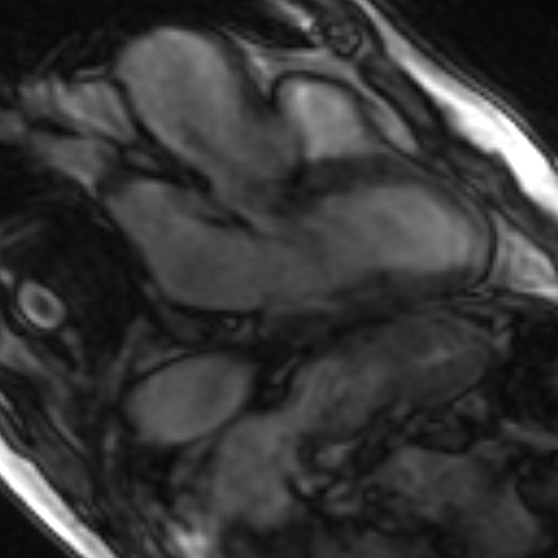 File:Anteroseptal hypokinesia after myocardial infarction (Radiopaedia 15978-15633 3 chamber view SSFE 10).jpg
