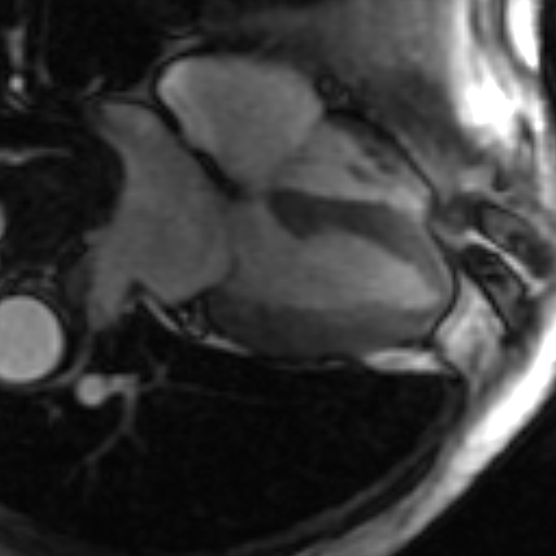 File:Anteroseptal hypokinesia after myocardial infarction (Radiopaedia 15978-15633 4 chamber view SSFE 7).jpg
