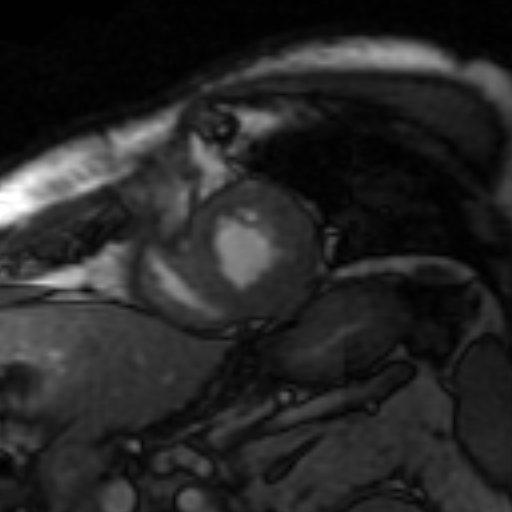 File:Anteroseptal hypokinesia after myocardial infarction (Radiopaedia 15978-15633 Short axis SSFE 9).jpg