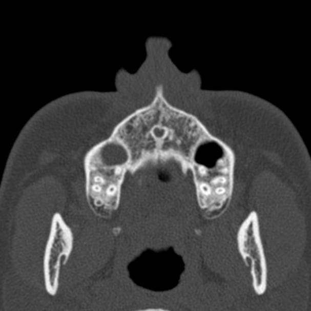 Antrochoanal polyp (Radiopaedia 33984-35202 Axial bone window 5).jpg