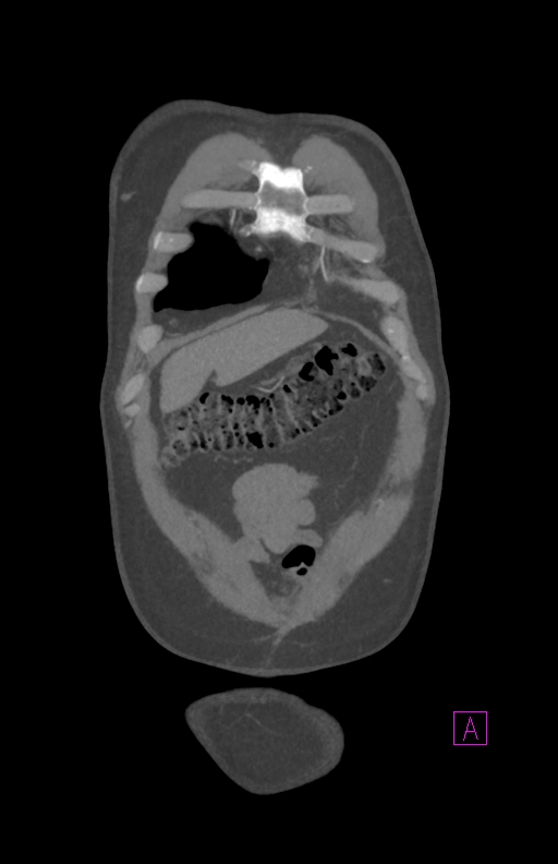 Aortectomy and axillary-bifemoral bypass (Radiopaedia 28303-28545 C 15).jpg