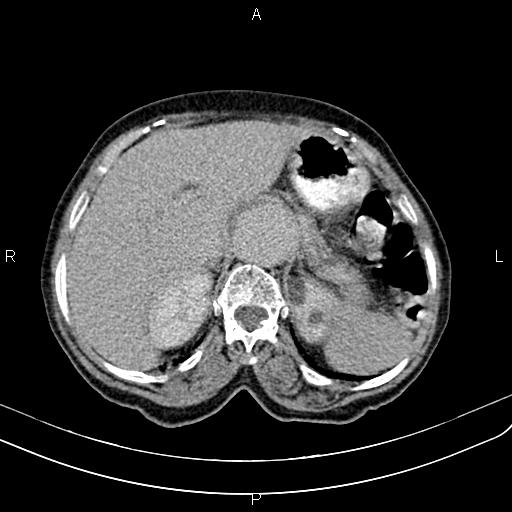 Aortic aneurysm and Lemmel syndrome (Radiopaedia 86499-102554 Axial C+ delayed 20).jpg