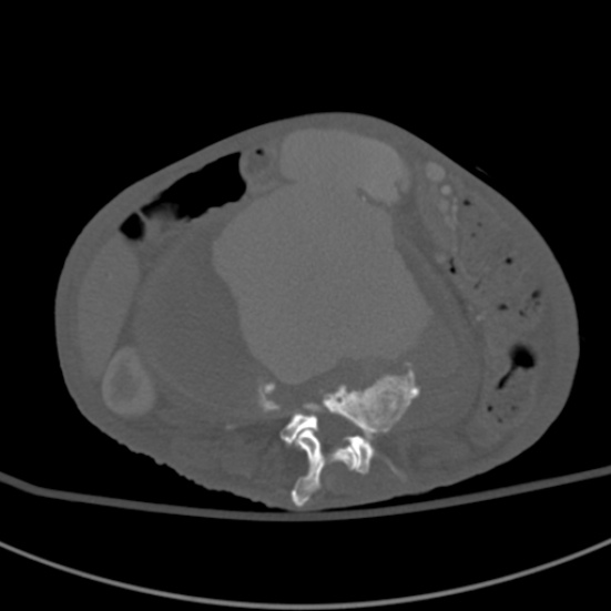 Aortic aneurysm with spinal destruction (Radiopaedia 42301-45410 Axial bone window 49).jpg