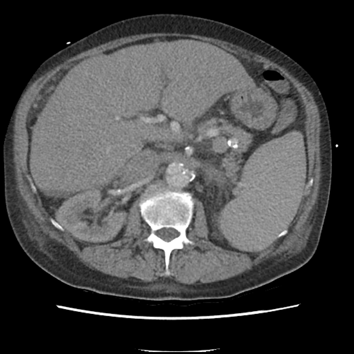 Aortic arch graft infection (FDG PET-CT) (Radiopaedia 71975-82437 A 72).jpg