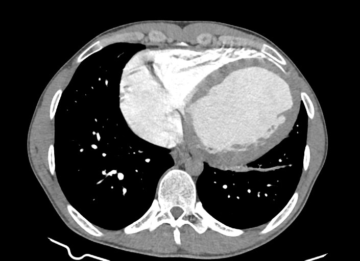 File:Aortic coarctation with aneurysm (Radiopaedia 74818-85828 A 71).jpg