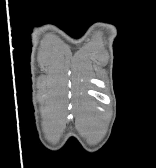 Aortic coarctation with aneurysm (Radiopaedia 74818-85828 C 115).jpg