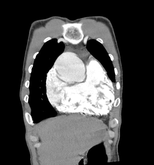 File:Aortic coarctation with aneurysm (Radiopaedia 74818-85828 C 22).jpg