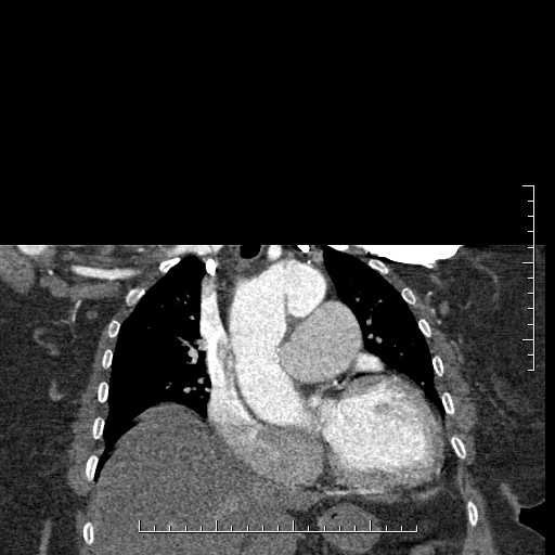 Aortic dissection- Stanford A (Radiopaedia 35729-37268 E 39).jpg