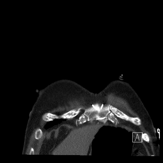 File:Aortic dissection (CTPA) (Radiopaedia 75506-86750 B 1).jpg