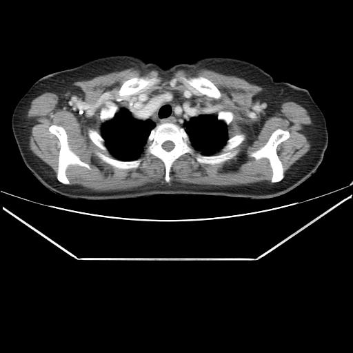 Aortic dissection (Radiopaedia 25350-25604 C 4).jpg