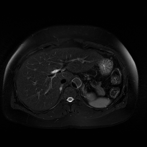 File:Aortic dissection (Radiopaedia 57969-64956 Axial T2 fat sat 21).jpg
