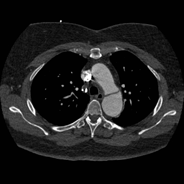 File:Aortic dissection (Radiopaedia 57969-64959 A 109).jpg