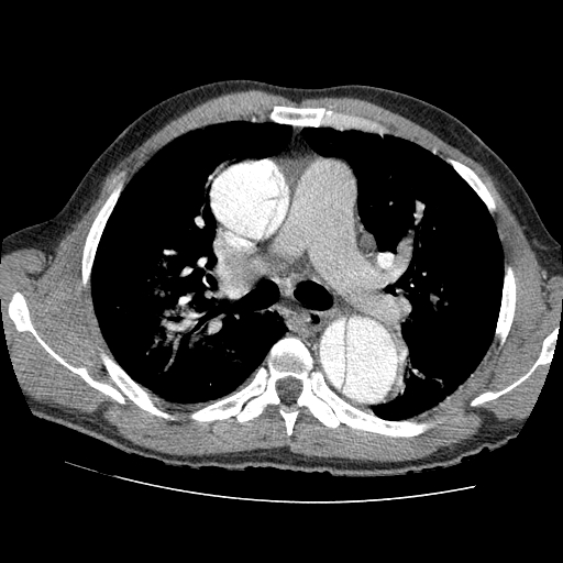 File:Aortic dissection - Stanford A -DeBakey I (Radiopaedia 28339-28587 B 33).jpg