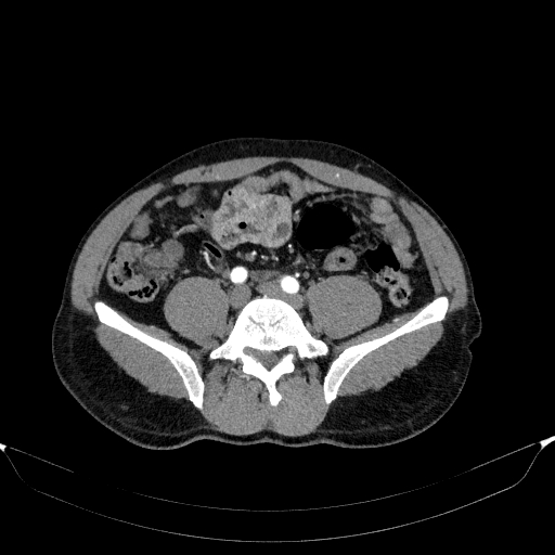 Aortic dissection - Stanford type A (Radiopaedia 83418-98500 A 95).jpg