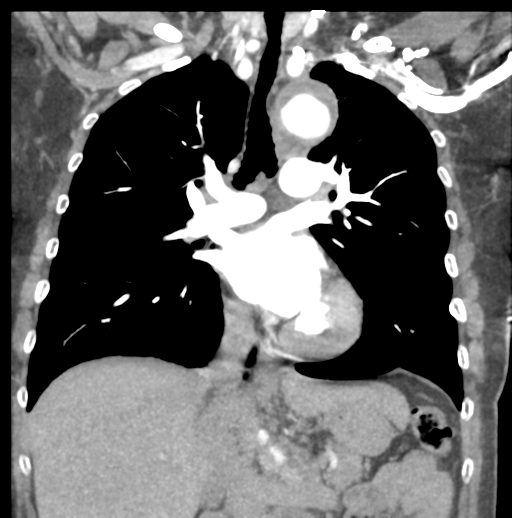 File:Aortic dissection - Stanford type B (Radiopaedia 50171-55512 B 42).png