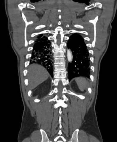 File:Aortic dissection - Stanford type B (Radiopaedia 73648-84437 B 98).jpg