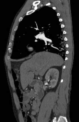 File:Aortic dissection - Stanford type B (Radiopaedia 73648-84437 C 103).jpg