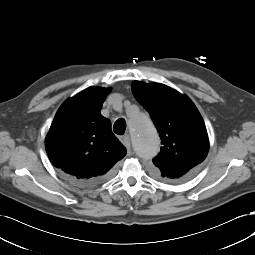 Aortic intramural hematoma (Radiopaedia 34260-35540 Axial non-contrast 16).png