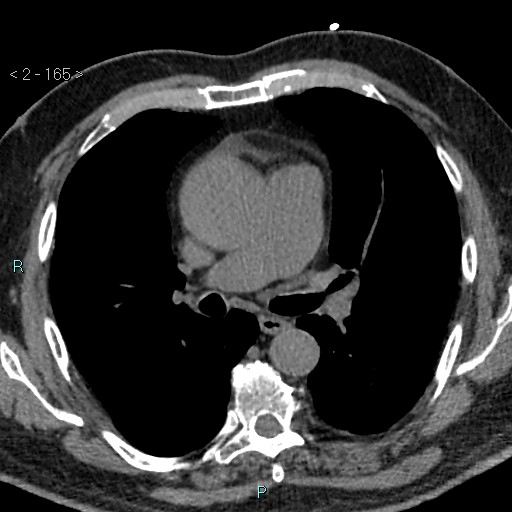 Aortic intramural hematoma (Radiopaedia 48463-53380 Axial non-contrast 73).jpg
