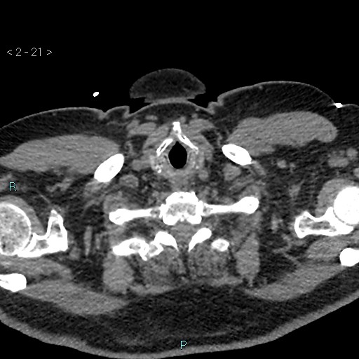 Aortic intramural hematoma (Radiopaedia 48463-53380 Axial non-contrast 9).jpg