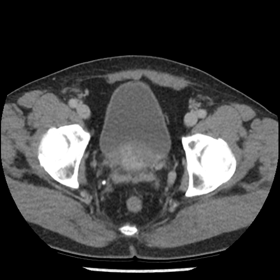 File:Aortic intramural hematoma (type B) (Radiopaedia 79323-92387 Axial C+ delayed 108).jpg