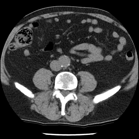 Aortic intramural hematoma (type B) (Radiopaedia 79323-92387 Axial non-contrast 82).jpg