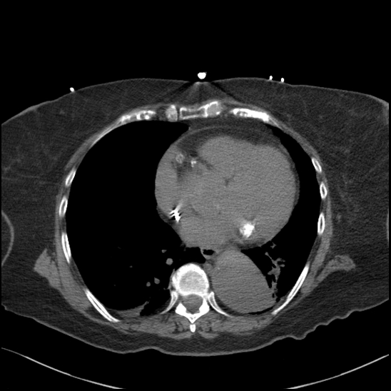 Aortic intramural hematoma with dissection and intramural blood pool (Radiopaedia 77373-89491 Axial non-contrast 61).jpg