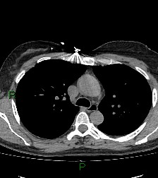 File:Aortic valve endocarditis (Radiopaedia 87209-103485 Axial non-contrast 38).jpg