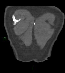 File:Aortic valve endocarditis (Radiopaedia 87209-103485 D 3).jpg