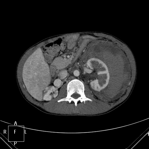 File:Aorto-left renal vein fistula (Radiopaedia 45534-49628 A 22).jpg