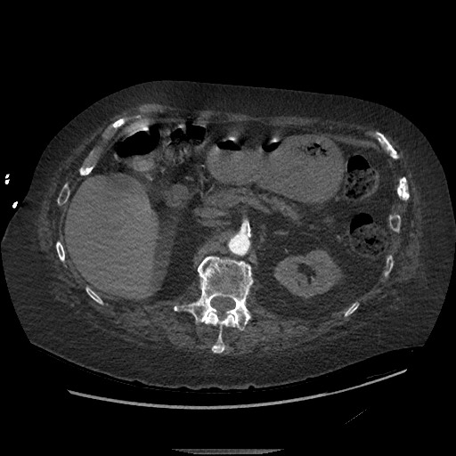 File:Aortoesophageal fistula with endovascular repair (Radiopaedia 73781-84592 Axial C+ CTPA 205).jpg