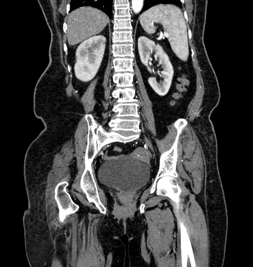 Aortoiliac occlusive disease (Radiopaedia 52352-58248 B 53).jpg