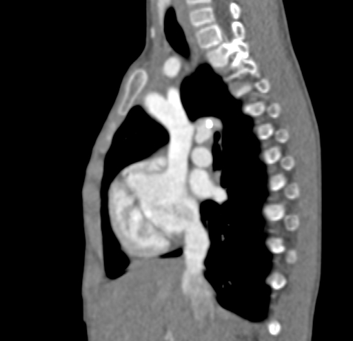 File:Aortopulmonary window, interrupted aortic arch and large PDA giving the descending aorta (Radiopaedia 35573-37074 C 4).jpg