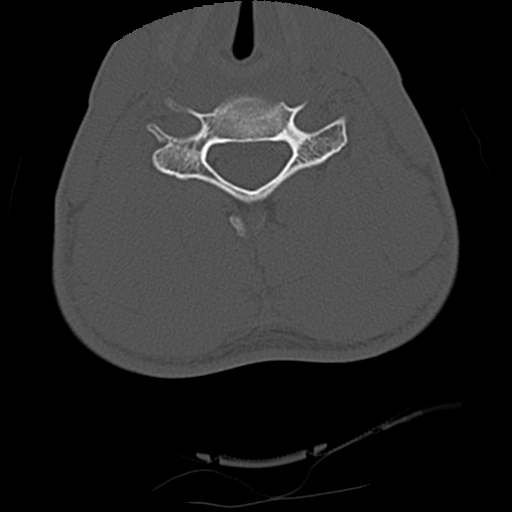 Apical pneumothorax on cervical spine CT (Radiopaedia 45343-49368 Axial bone window 58).jpg