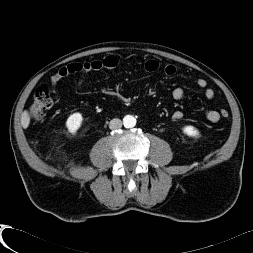 File:Appendiceal adenocarcinoma complicated by retroperitoneal abscess (Radiopaedia 58007-65039 B 77).jpg