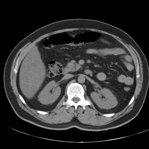 File:Appendicitis and giant appendicolith (Radiopaedia 80251-93588 Axial non-contrast 19).jpg