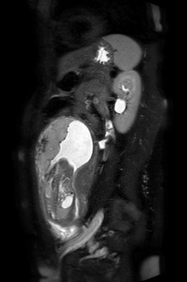 Appendicitis in gravida (MRI) (Radiopaedia 89433-106395 Sagittal T2 SPAIR 22).jpg