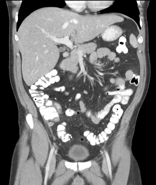 Appendicitis with cecal bar sign (Radiopaedia 31878-32830 A 27).jpg