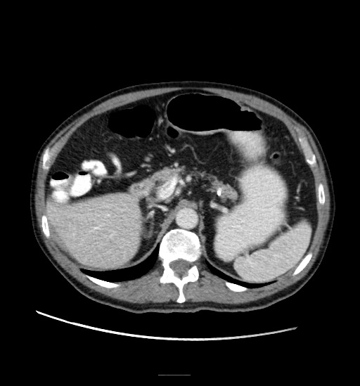 Appendicitis with localized perforation and abscess formation (Radiopaedia 49035-54130 A 29).jpg