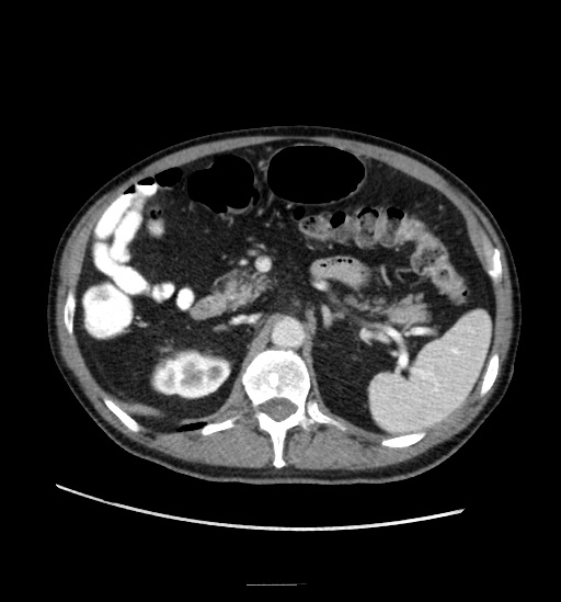 Appendicitis with localized perforation and abscess formation (Radiopaedia 49035-54130 A 33).jpg